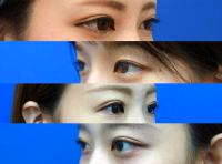 Blepharoplasty Asian Eyes Photo