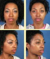 Blepharoplasty Before And After African American Picture