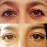 Blepharoplasty For Droopy Eyelids Before And After Pic