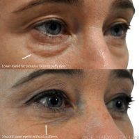 Blepharoplasty Is Surgery For Bags And Dark Circles Under The Eyes
