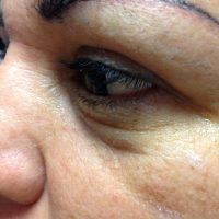 Blepharoplasty Surgery Can Help You Look Younger