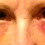 Blepharoplasty recovery swelling pictures