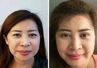 Double Eyelid Surgery Procedure Before After Pic