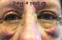 Eye surgery blepharoplasty recovery day 4 post op