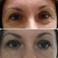 Eyelid Surgery For Droopy Or Baggy Eyelids