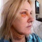 Eyelid surgery blepharoplasty recovery photos