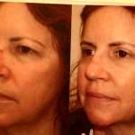 Eyelid surgery recovery photos before and after