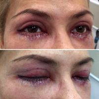 Get Blepharoplasty And Look Younger