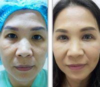 Korean Eyelid Surgery Before After Picture