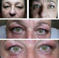 Look Younger With Blepharoplasty