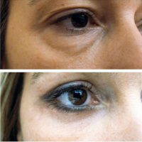 Lower Eyelid Surgery Before And After Pic