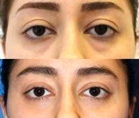 Surgery For Excessive Drooping And Sagging Of Skin Around Eyes
