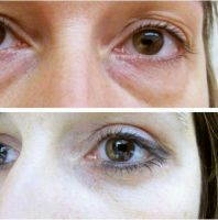 Transconjunctival Lower Eyelid Blepharoplasty Before After Photo