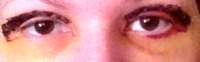 Upper eyelid blepharoplasty recovery after 4 days