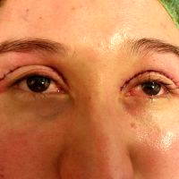 What Is Upper Blepharoplasty Picture