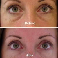Alternative to lower eyelid surgery before and after pictures
