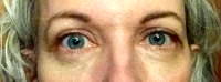 Alternative to lower eyelid surgery pictures
