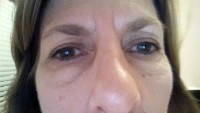  blepharoplasty eyelid surgery patients