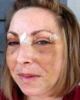 Blepharoplasty and brow lift recovery photos