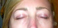 Eyelid surgery stitches pictures