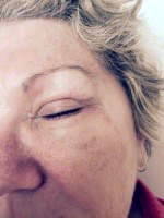Scars after eyelid surgery image