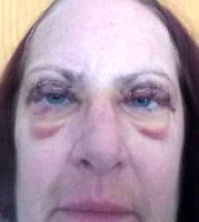 Stitches after blepharoplasty recovery