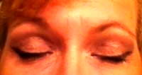 What is a blepharoplasty photos