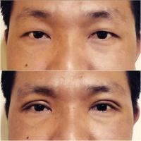 Asian Blepharoplasty Procedure Before And After