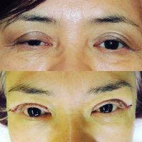 Female Upper Blepharoplasty Photo Before And After