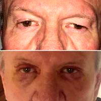 Lower Blepharoplasty Can Involve Skin Incisions Directly Below The Lash Line
