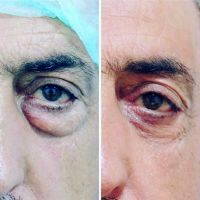 Male Upper Blepharoplasty Before And After Picture