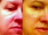 Before And After Lower Lid Blepharoplasty