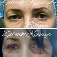Contour Upper And Lower Eyelids With Laser