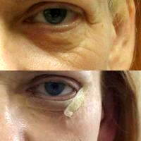 Get Laser Eyelid Surgery To Remove Bags Under Eyes