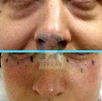 Laser For Lower Eyelid Surgery
