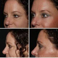 Lower Blepharoplasty Also Can Improve Your Vision