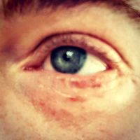 Lower Blepharoplasty For Under Eye Wrinkles