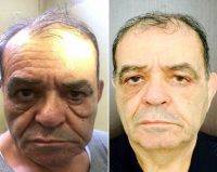 Male Lower Blepharoplasty Before And After Photos