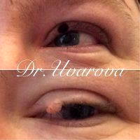Many Doctors Achieve Beautiful, Healthy Results With Both Kinds Of Eyelid Surgery