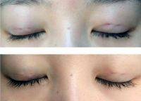 After Asian Eyelid Surgery