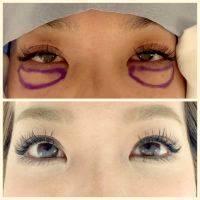 Asian Eye Surgery Before And After