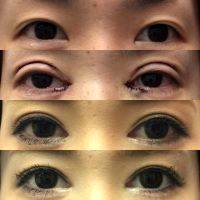 Asian Eyelid Surgery Produces Permanent Eyelid Creases