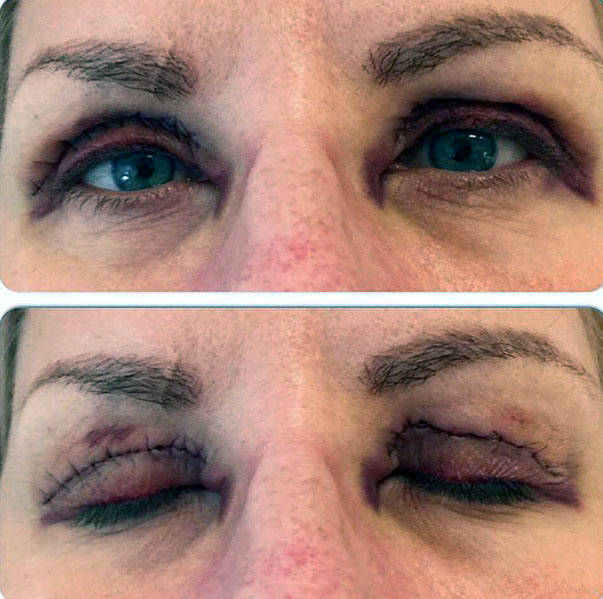 Top 50 Blepharoplasty Surgeons Eyelid Surgery Cost Photos Rewiews Qanda