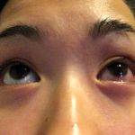 Chemosis Is A Nonspecific Sign Of Eye Irritation