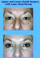 David S Felder Eyelid Surgery With Laser Resurfacing Before And After