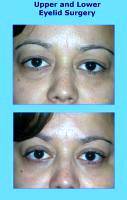 David S Felder Upper And Lower Eyelid Surgery Before And After