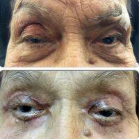Absorbable Suture Compared With Nonabsorbable Suture In Blepharoplasty