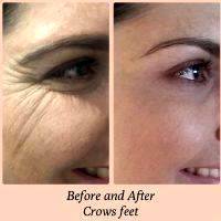 Before And After Crows Feet Wrinkles