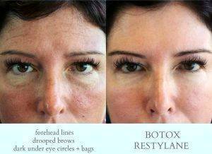 Botox Brow Lift Before And After Photos