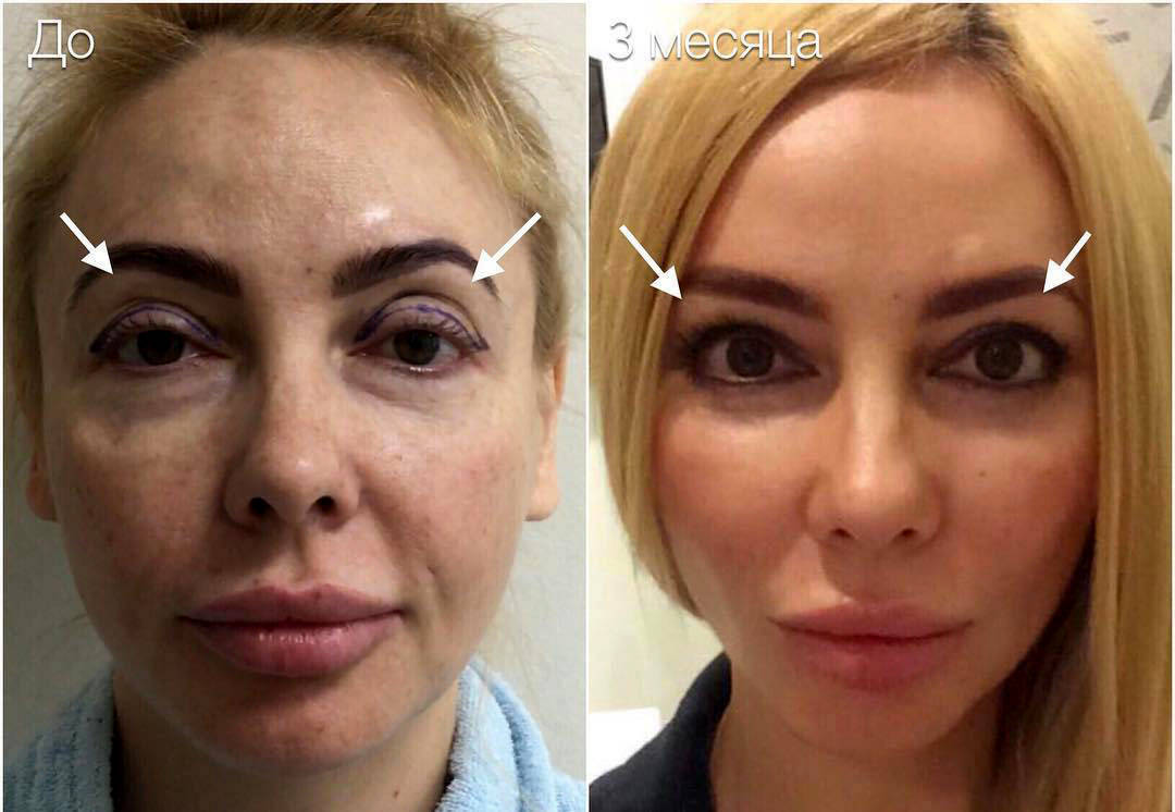 Facelift With Blepharoplasty » Eyelid Surgery Cost, Photos, Rewiews, Q&A